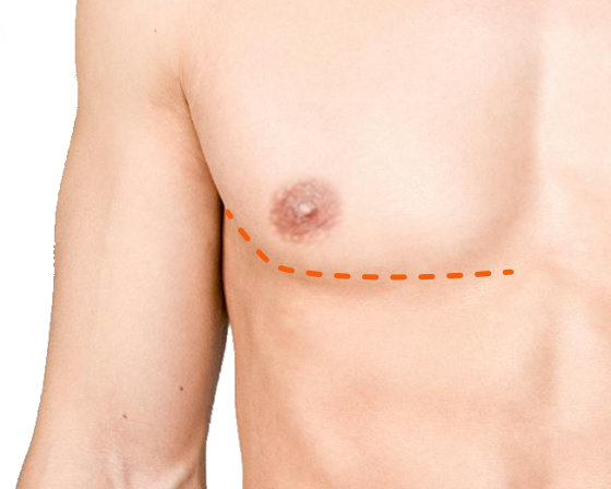 Nipple-Preserving Inferior-Ellipse Mastectomy