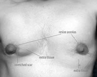 Top Surgery Revisions: Causes, Costs, and Considerations